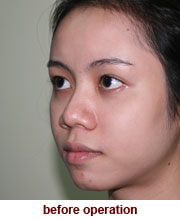 plastic_surgery_augmentation_rhinoplasty